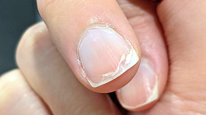 Solutions pour lutter contre les Problèmes des Ongles Fragiles, Dédoublés et Secs